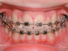 Brace