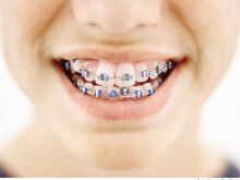 Brace
