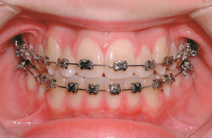 Brace