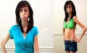 Lizzie Velasquez