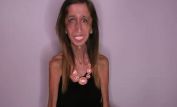 Lizzie Velasquez