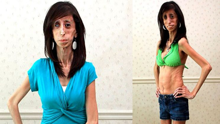 Lizzie Velasquez